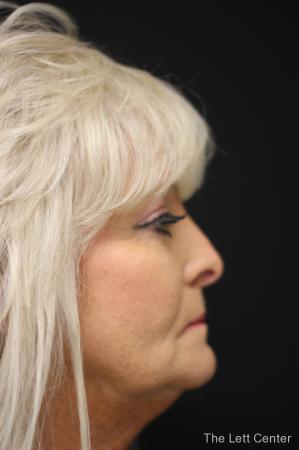 Blepharoplasty: Patient 1 - After Image 2