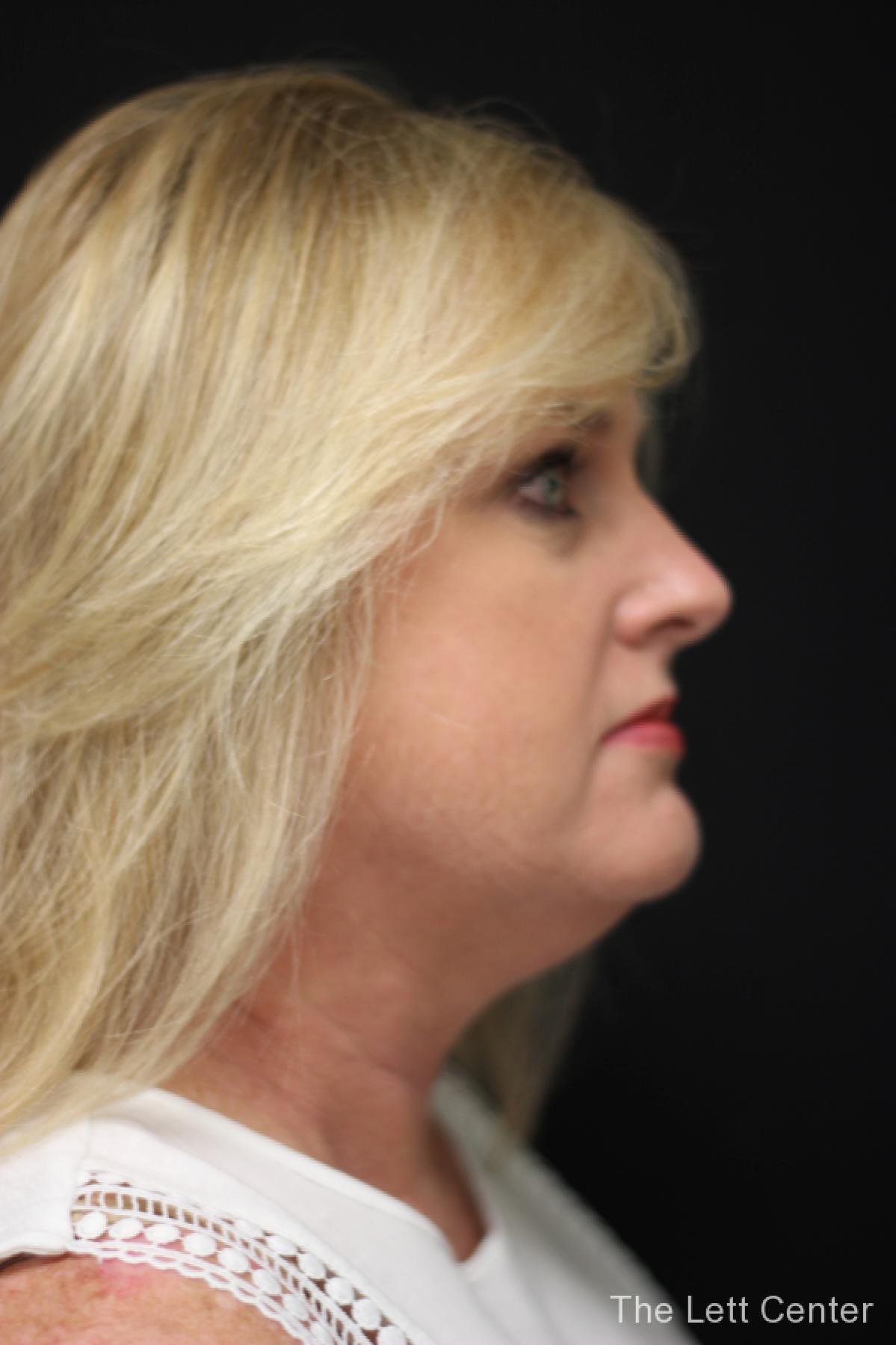 FaceTite treatments at The Lett Center in Lebanon, TN - Before and After 3