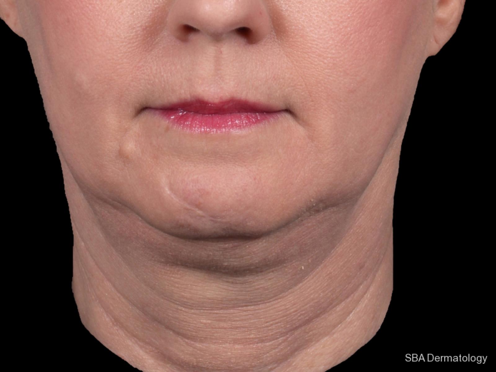 Kybella- Face: Patient 1 - Before 