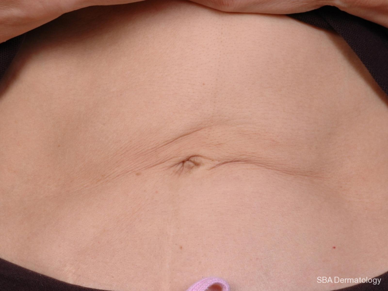 Sculptra-Body: Patient 3 - Before 