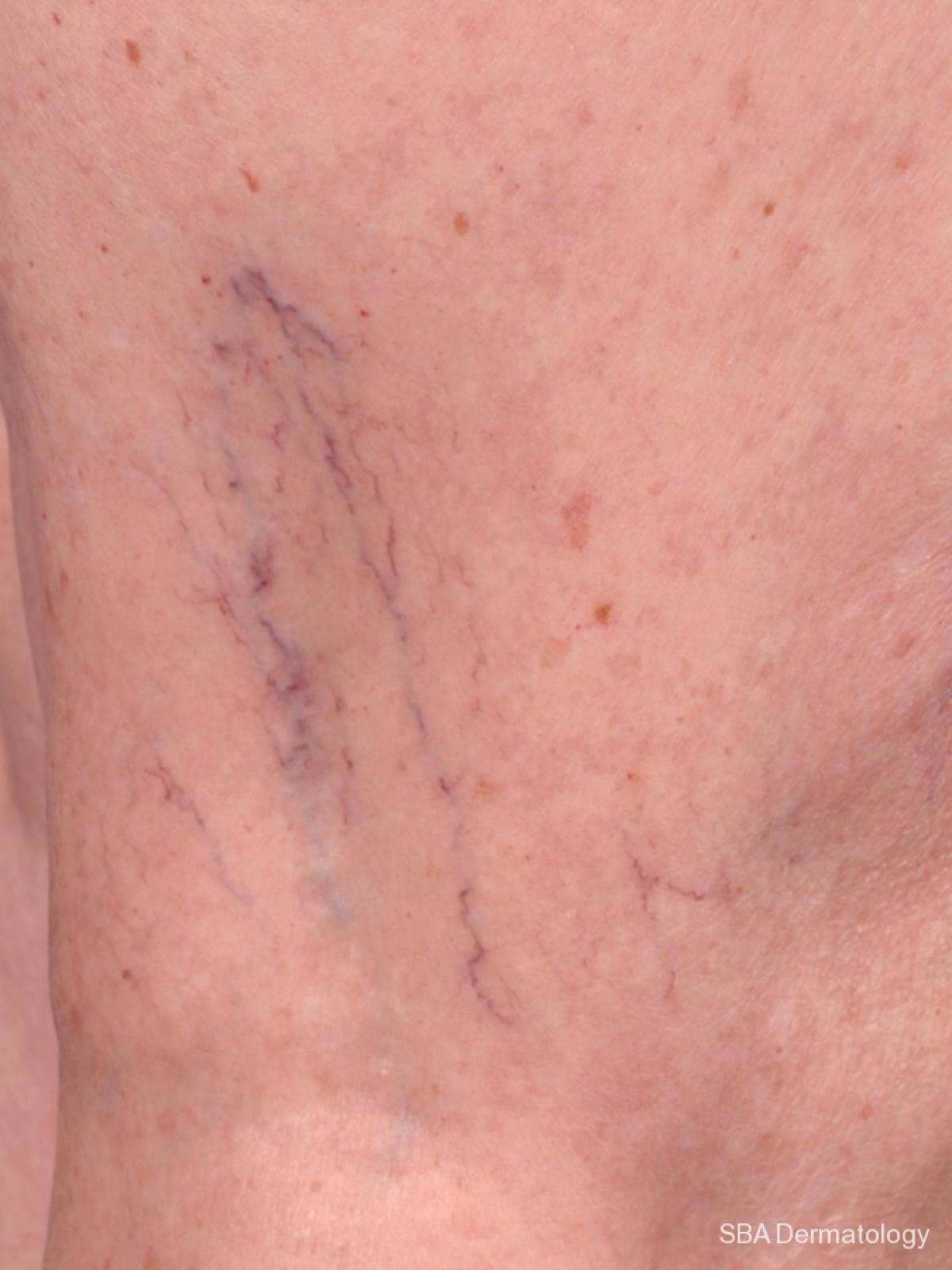 Sclerotherapy: Patient 1 - Before 