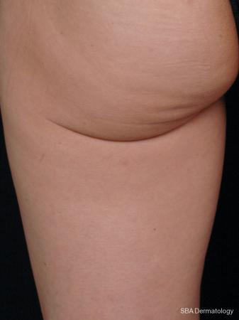 Thermage-Body: Patient 1 - After 1