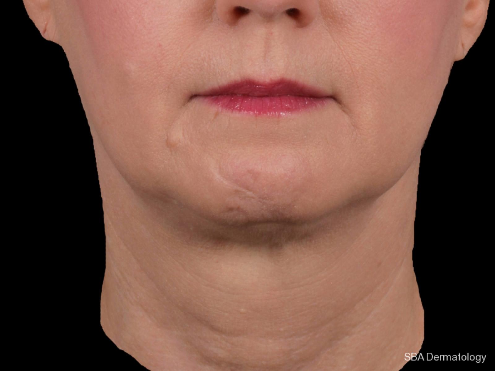 Kybella- Face: Patient 1 - After 1