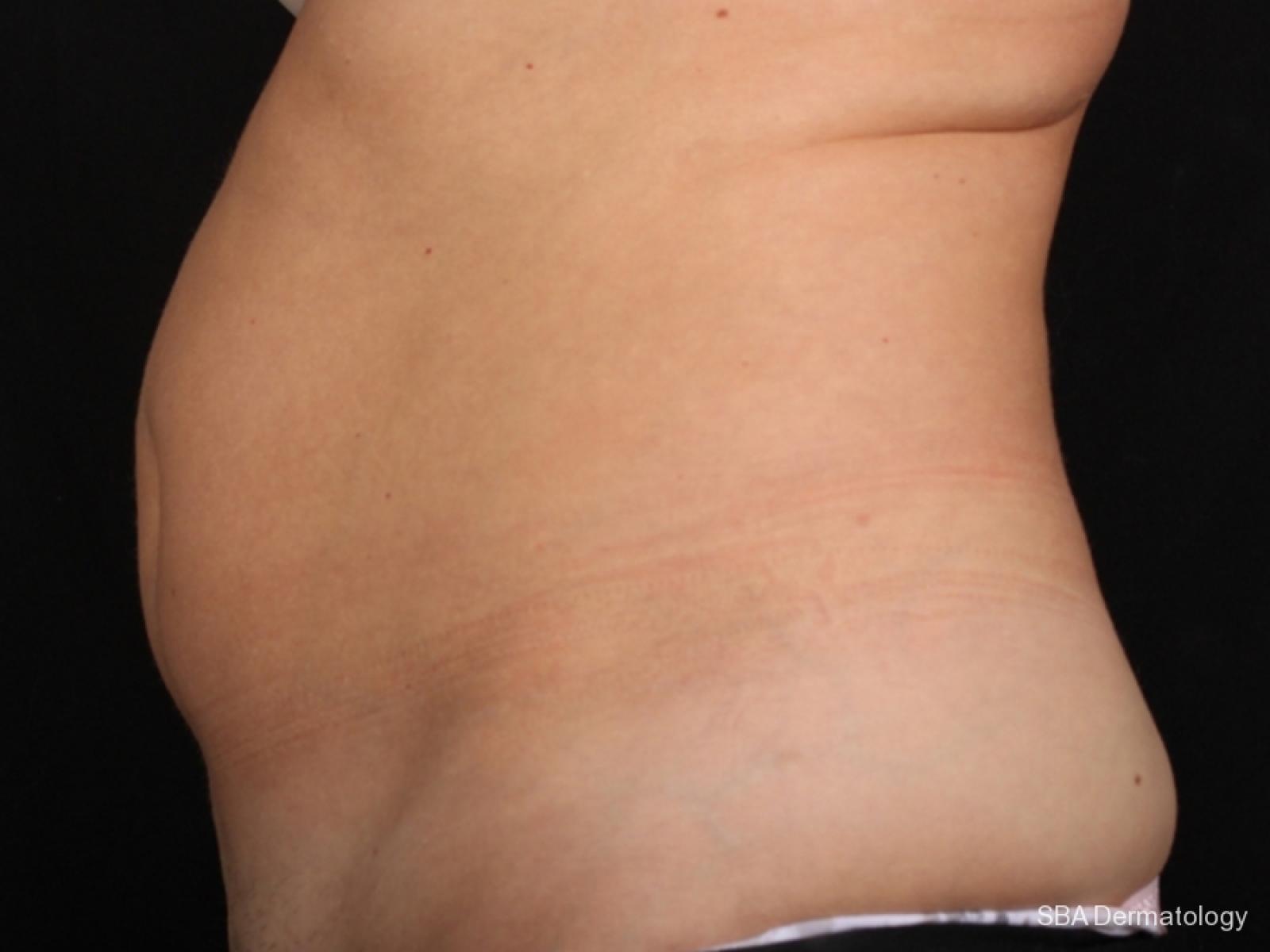 Coolsculpting: Patient 4 - Before 1