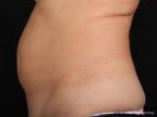 Coolsculpting: Patient 4 - Before 