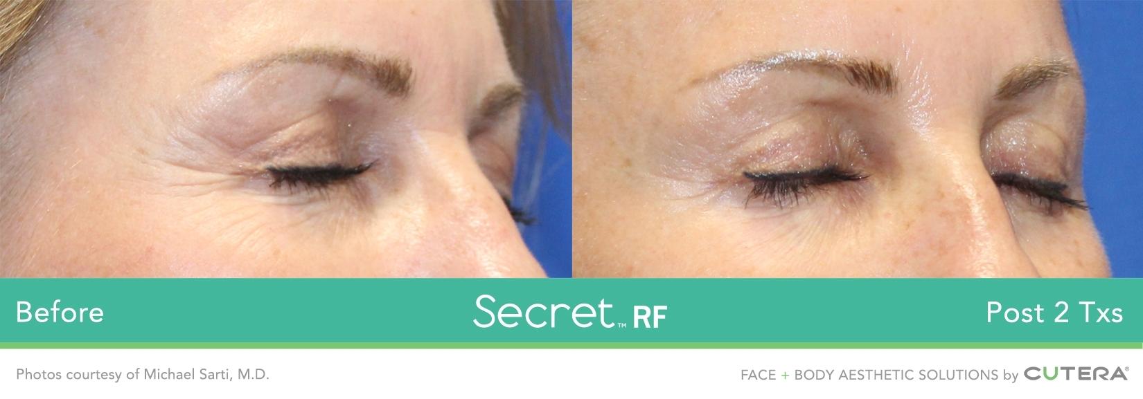 Secret RF: Patient 11 - Before and After 1