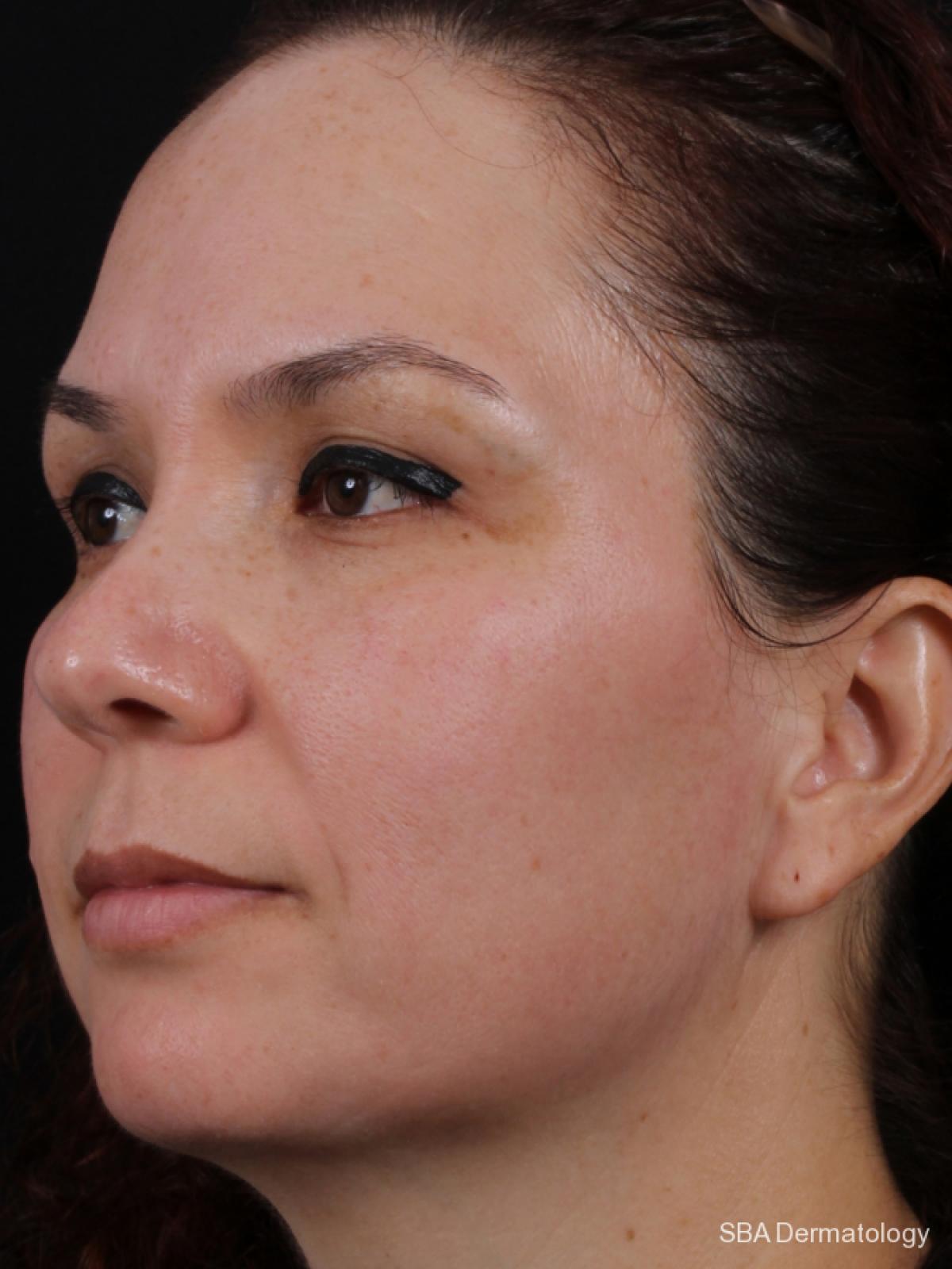 Chemical Peels: Patient 1 - After 1