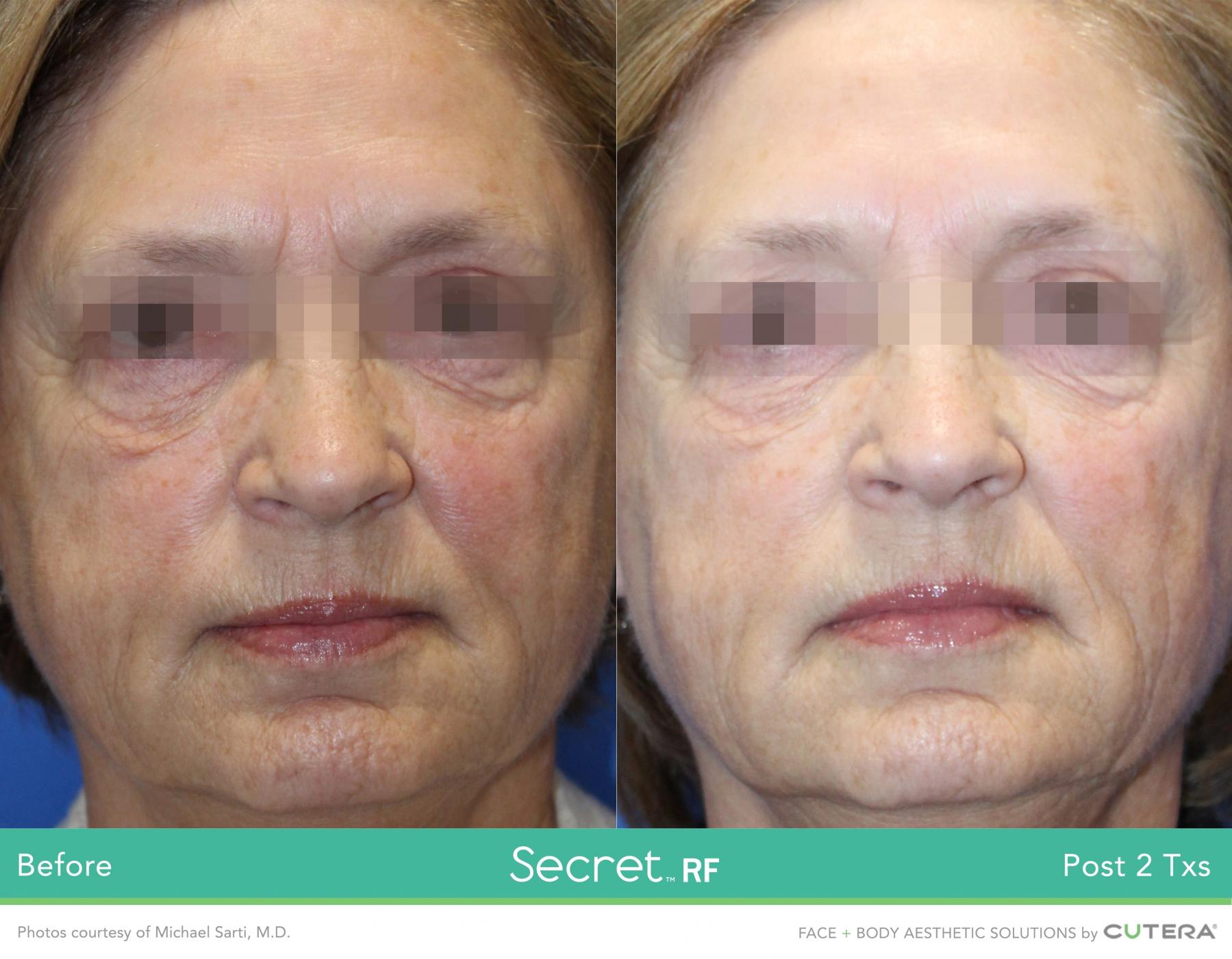 Secret RF: Patient 15 - Before and After 1