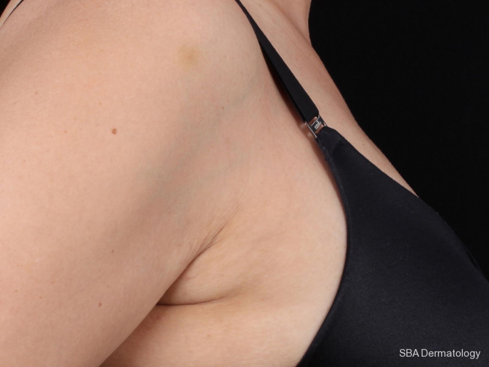 Kybella-Body: Patient 2 - Before 