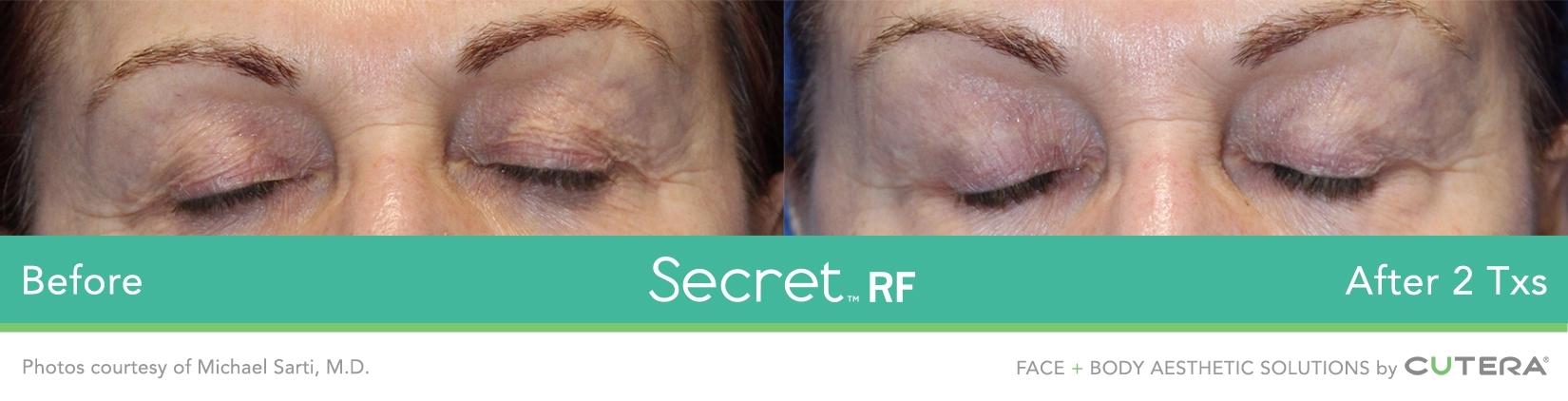 Secret RF: Patient 10 - Before and After  