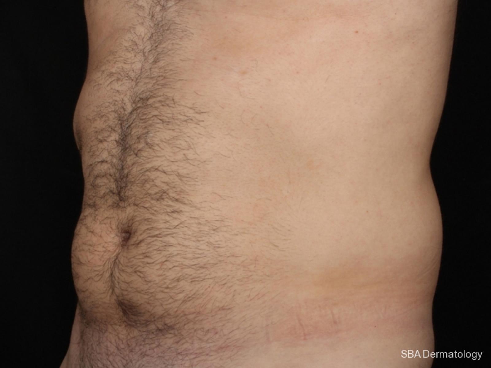 Coolsculpting: Patient 2 - Before 