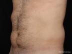 Coolsculpting: Patient 2 - Before 