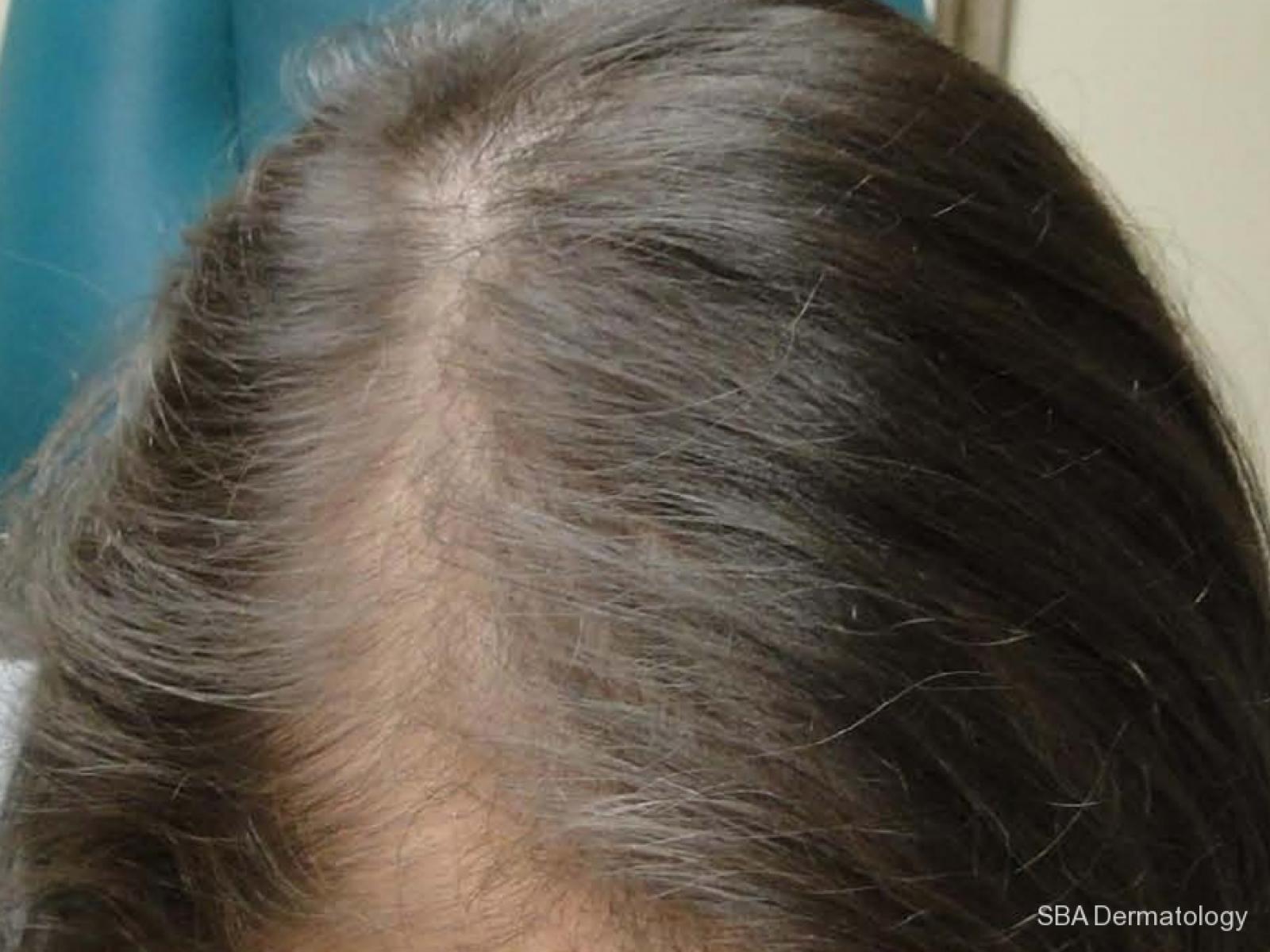 PRP For Hair Loss: Patient 2 - After  