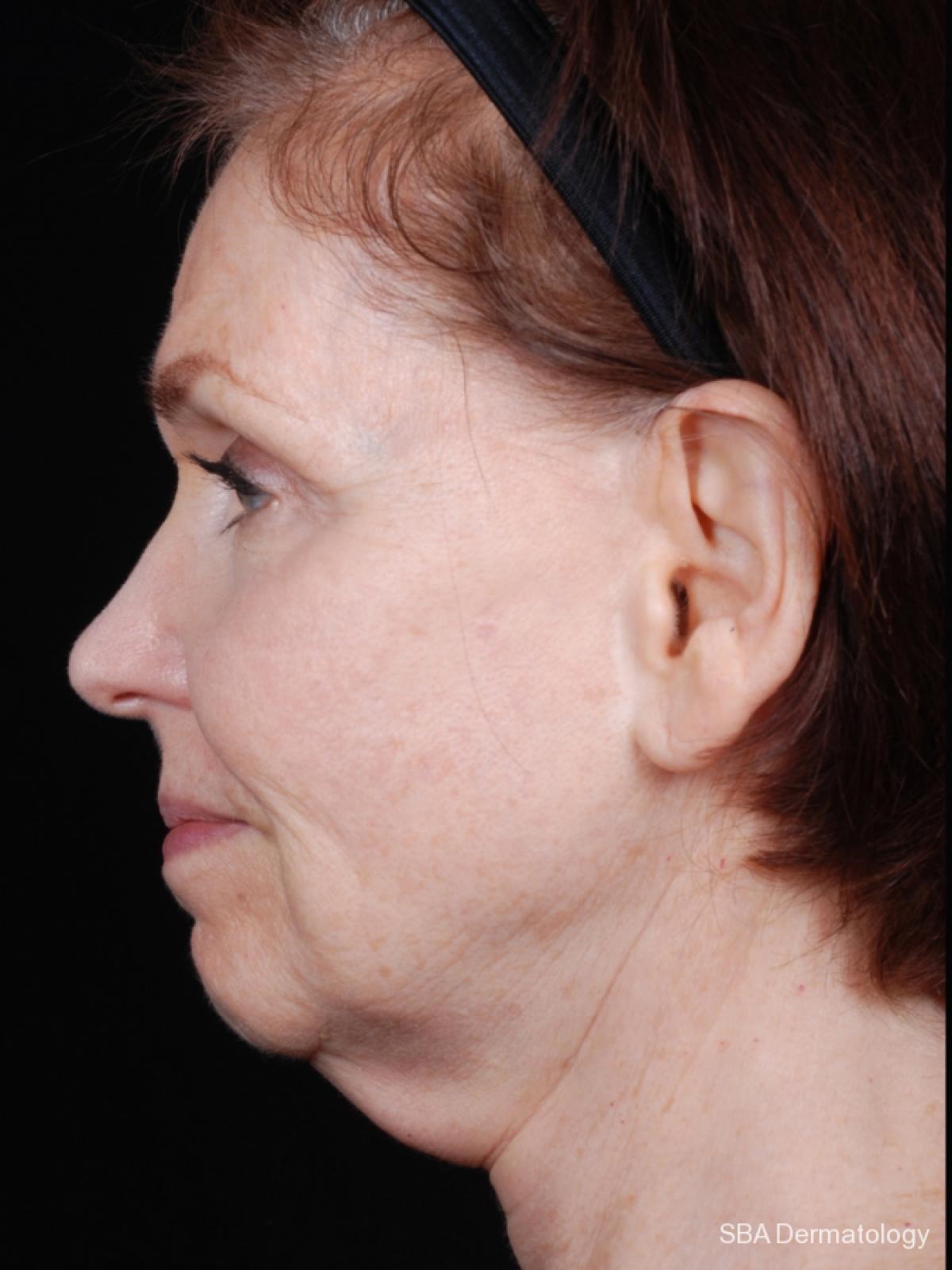 Ultherapy: Patient 2 - Before 1