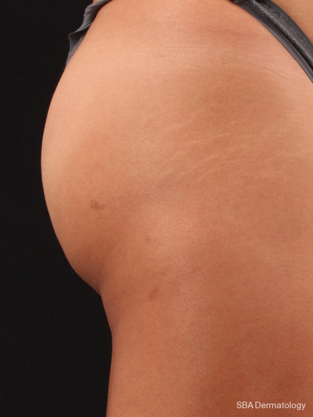 Sculptra-Body: Patient 2 - Before 1