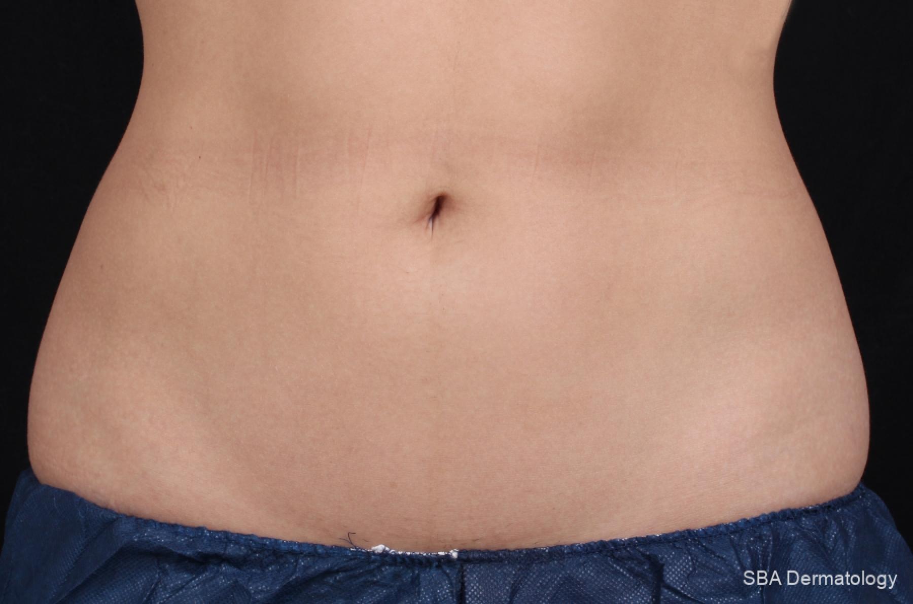 Velashape: Patient 6 - After 1