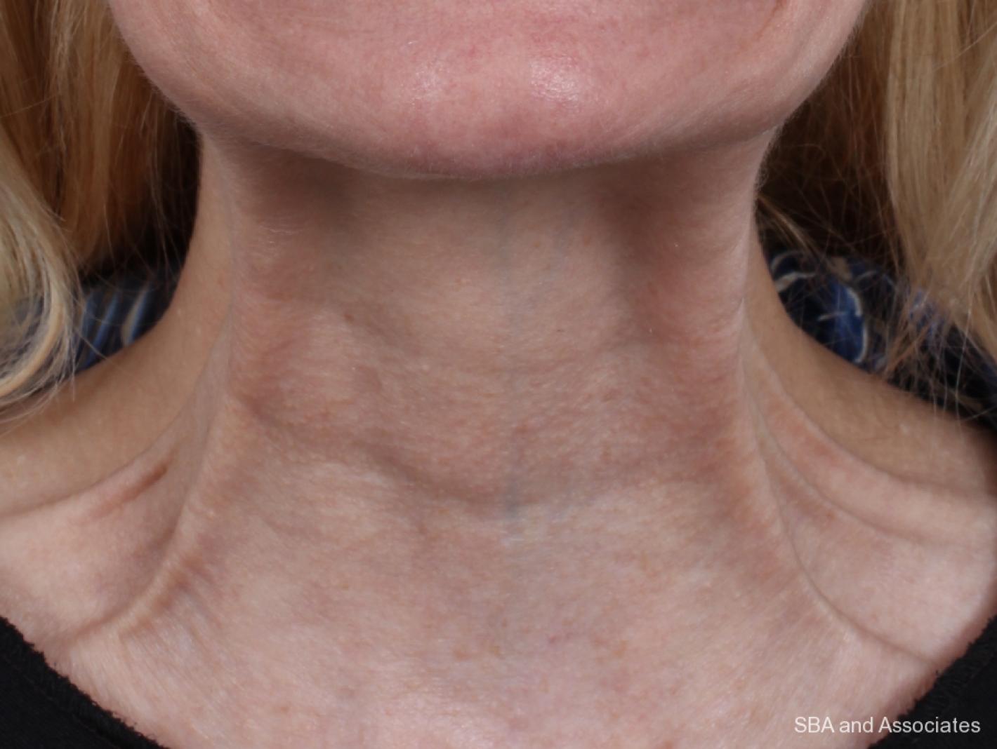 Botox: Patient 6 - After 2
