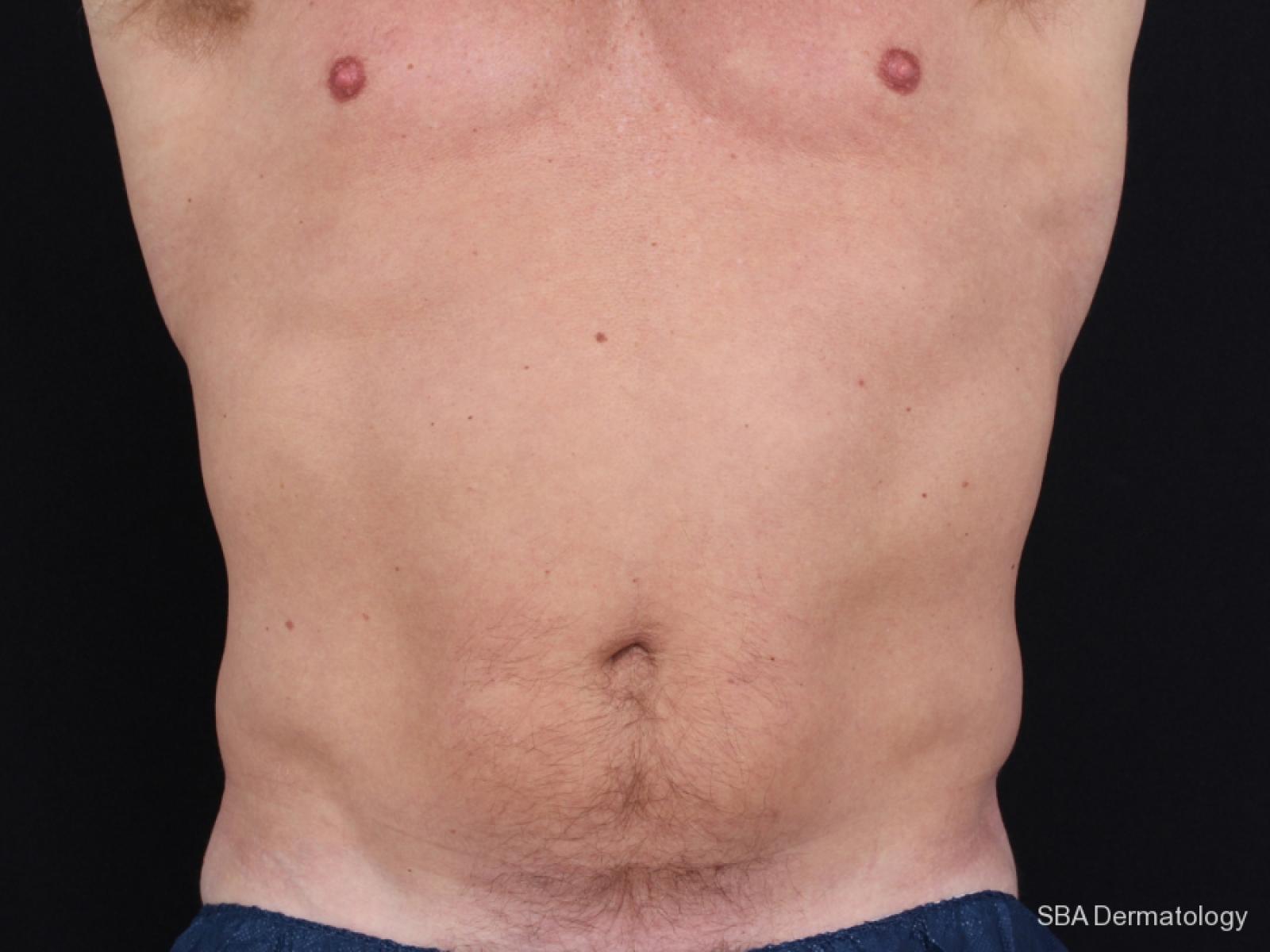 Coolsculpting: Patient 3 - Before 
