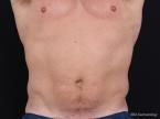 Coolsculpting: Patient 3 - Before 