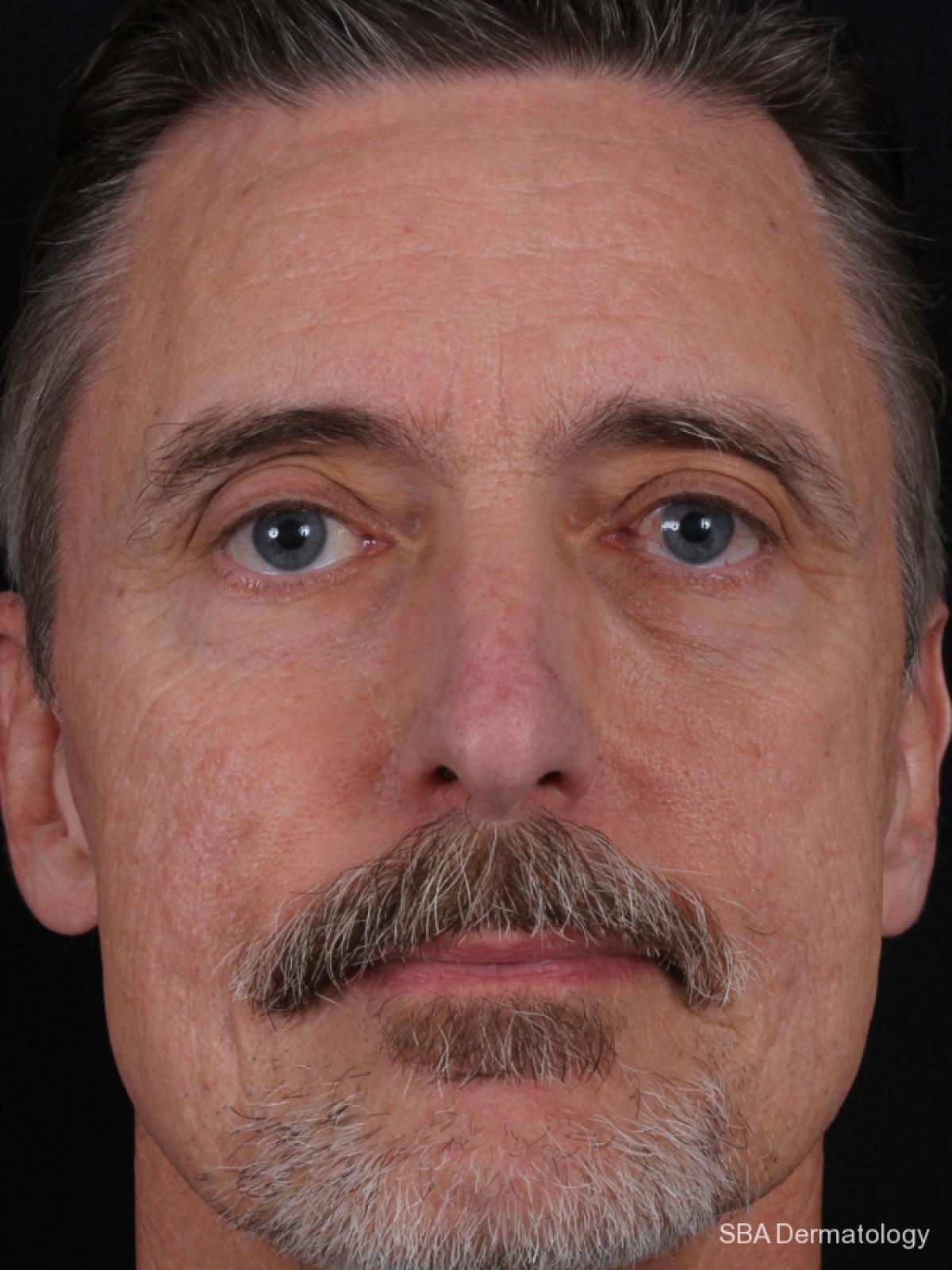 HA Filler: Patient 15 - After 1