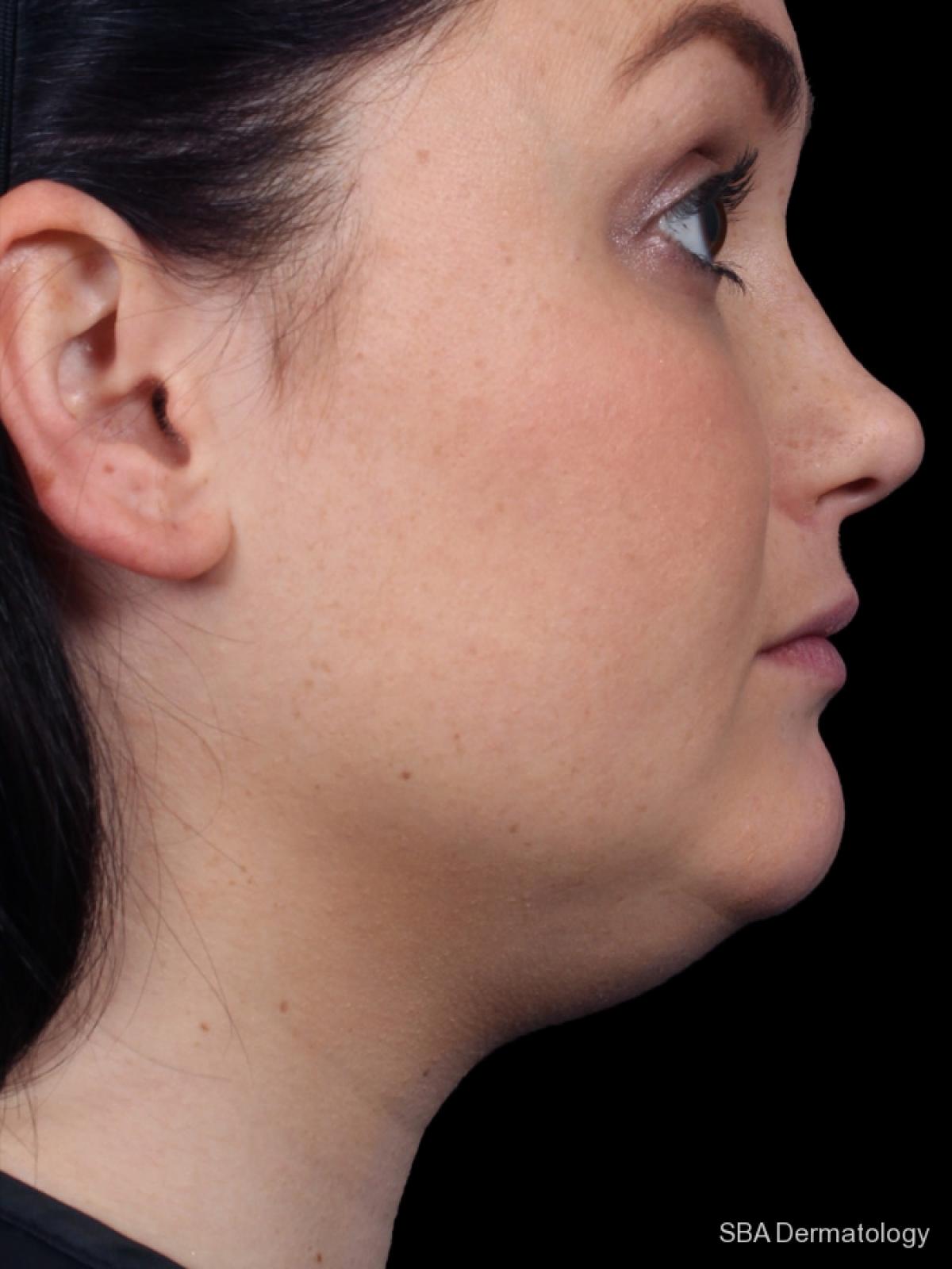 Kybella- Face: Patient 2 - Before 1