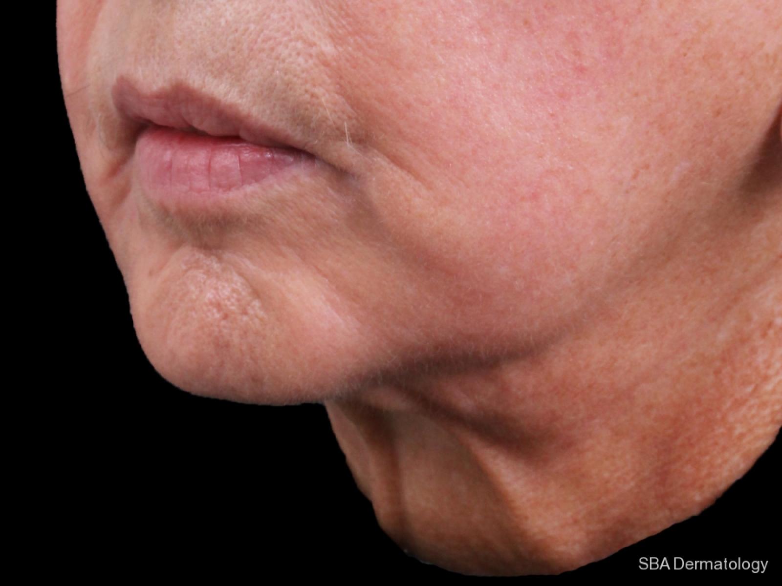 Ultherapy: Patient 1 - Before 