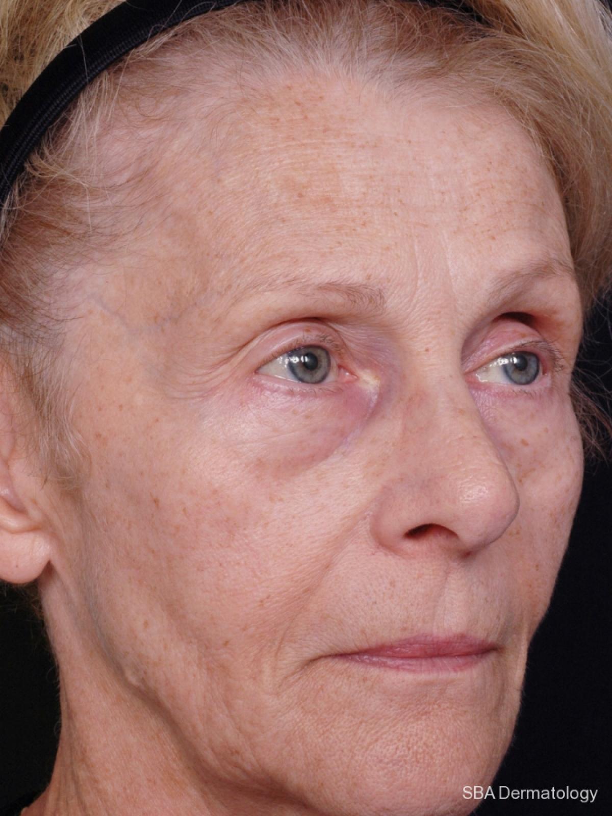 Sculptra-Face: Patient 2 - Before 1