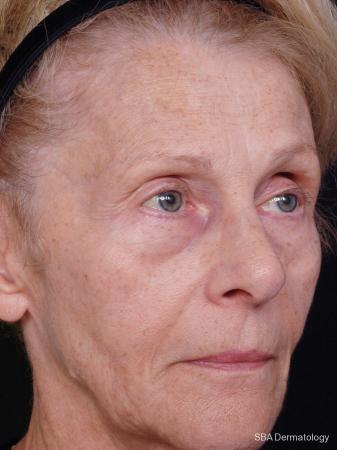 Sculptra-Face: Patient 2 - Before Image 1