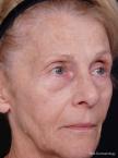 Sculptra-Face: Patient 2 - Before 