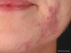 IPL-Photofacial: Patient 3 - Before 