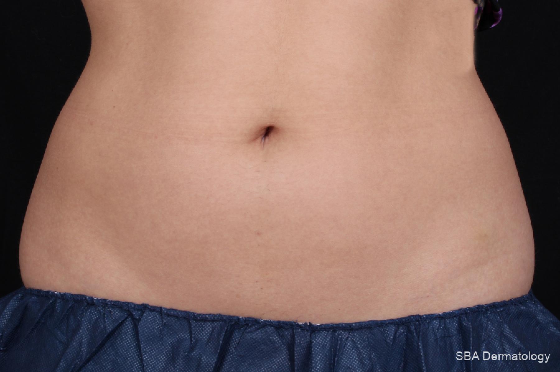 Velashape: Patient 6 - Before 1