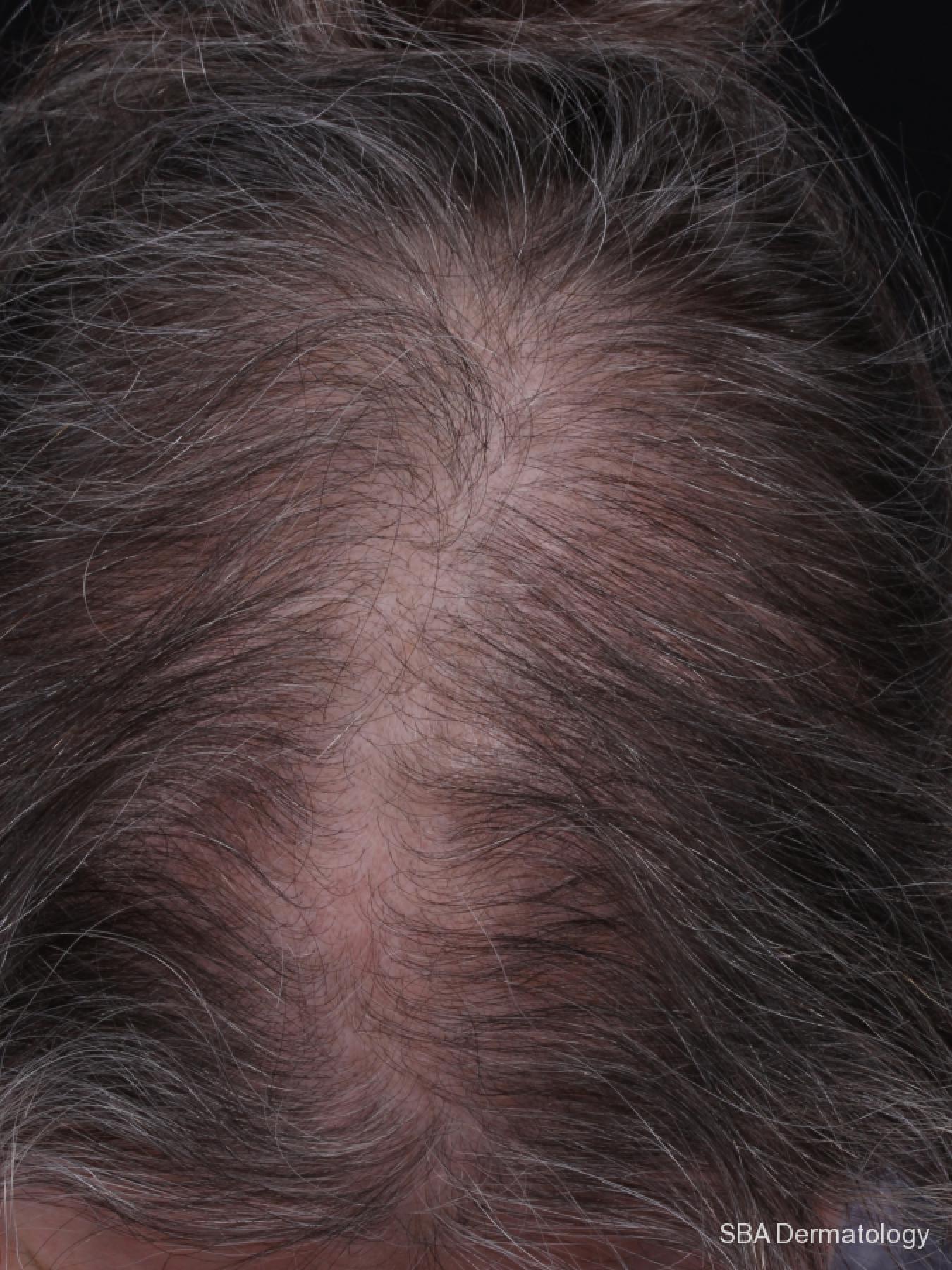 PRP For Hair Loss: Patient 3 - Before 1