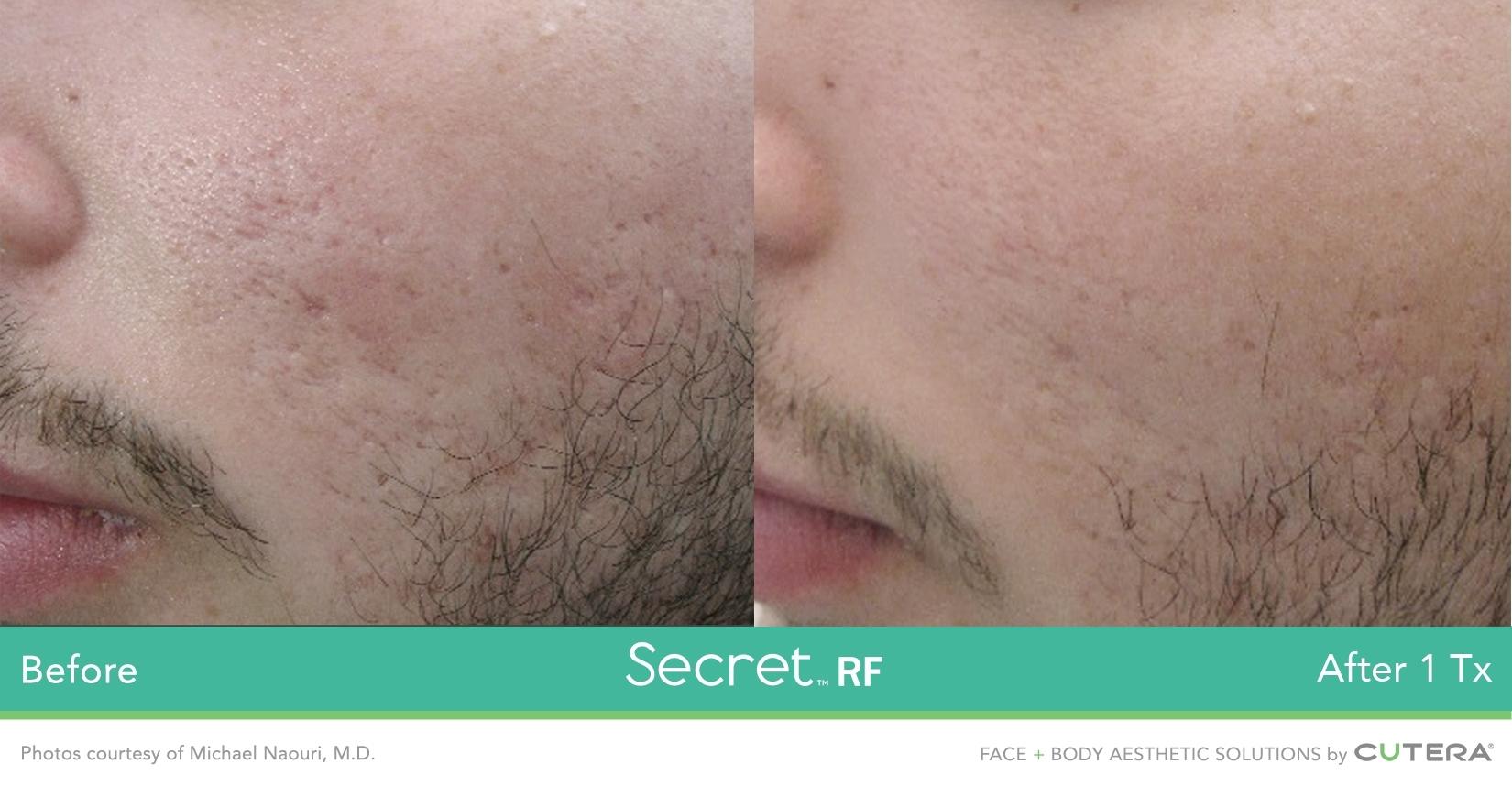 Secret RF: Patient 3 - Before and After  