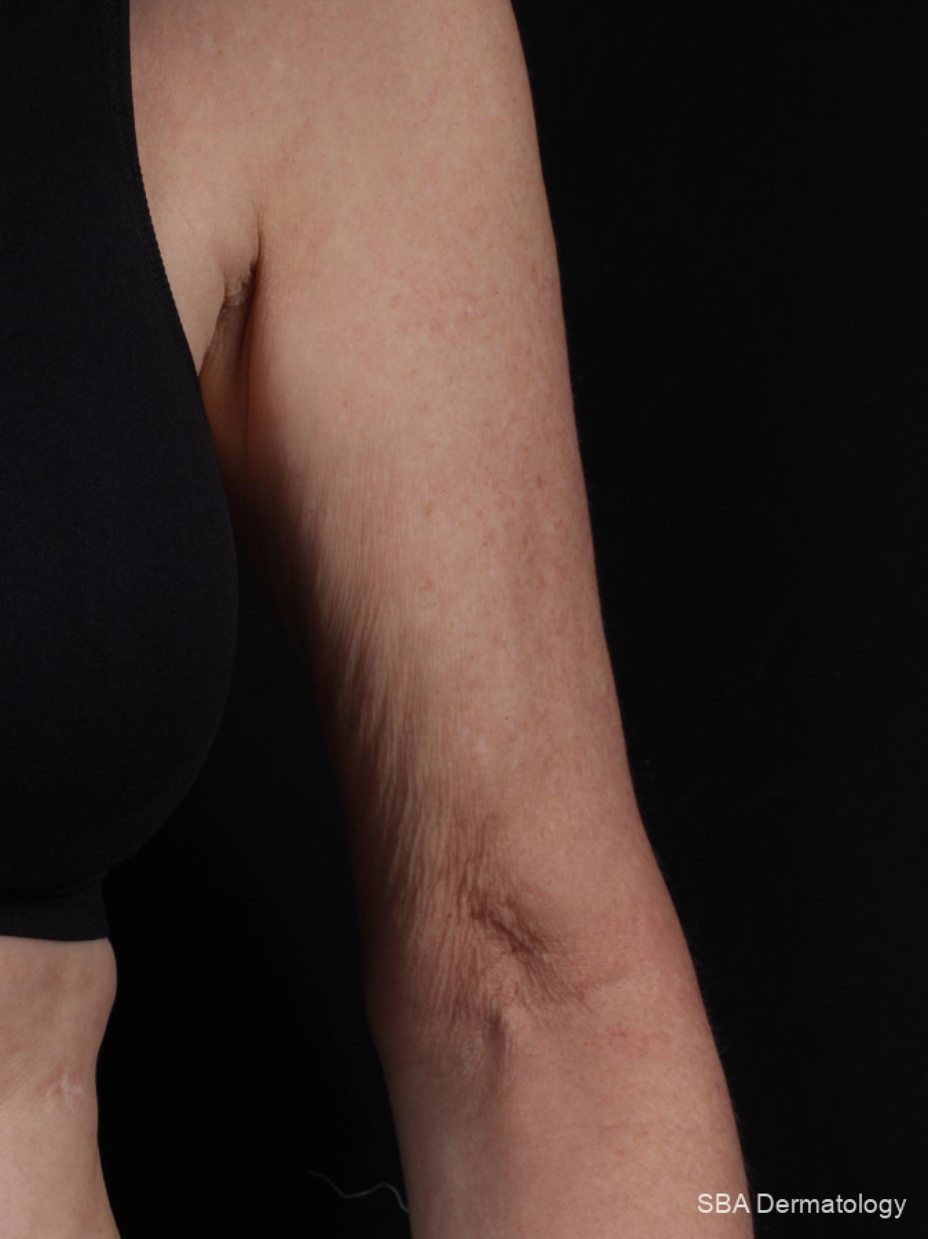 Velashape: Patient 2 - Before 1