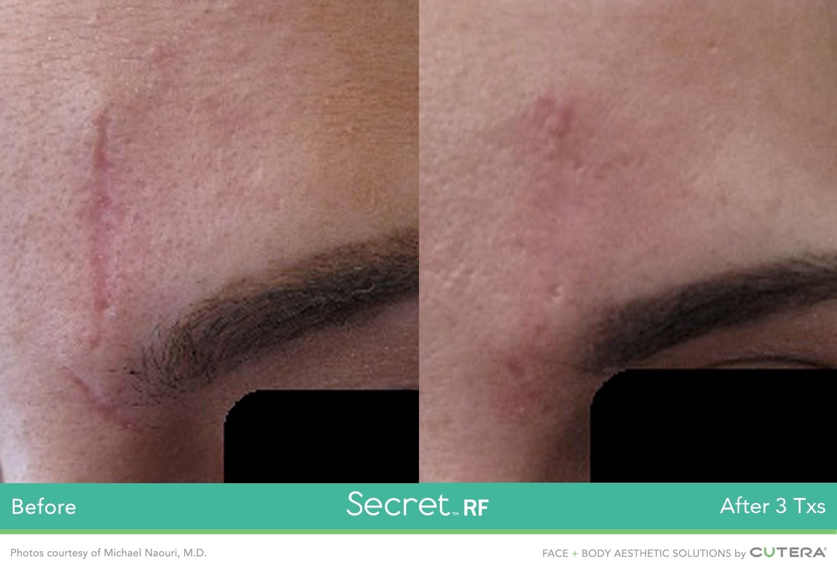 Secret RF: Patient 4 - Before and After 1