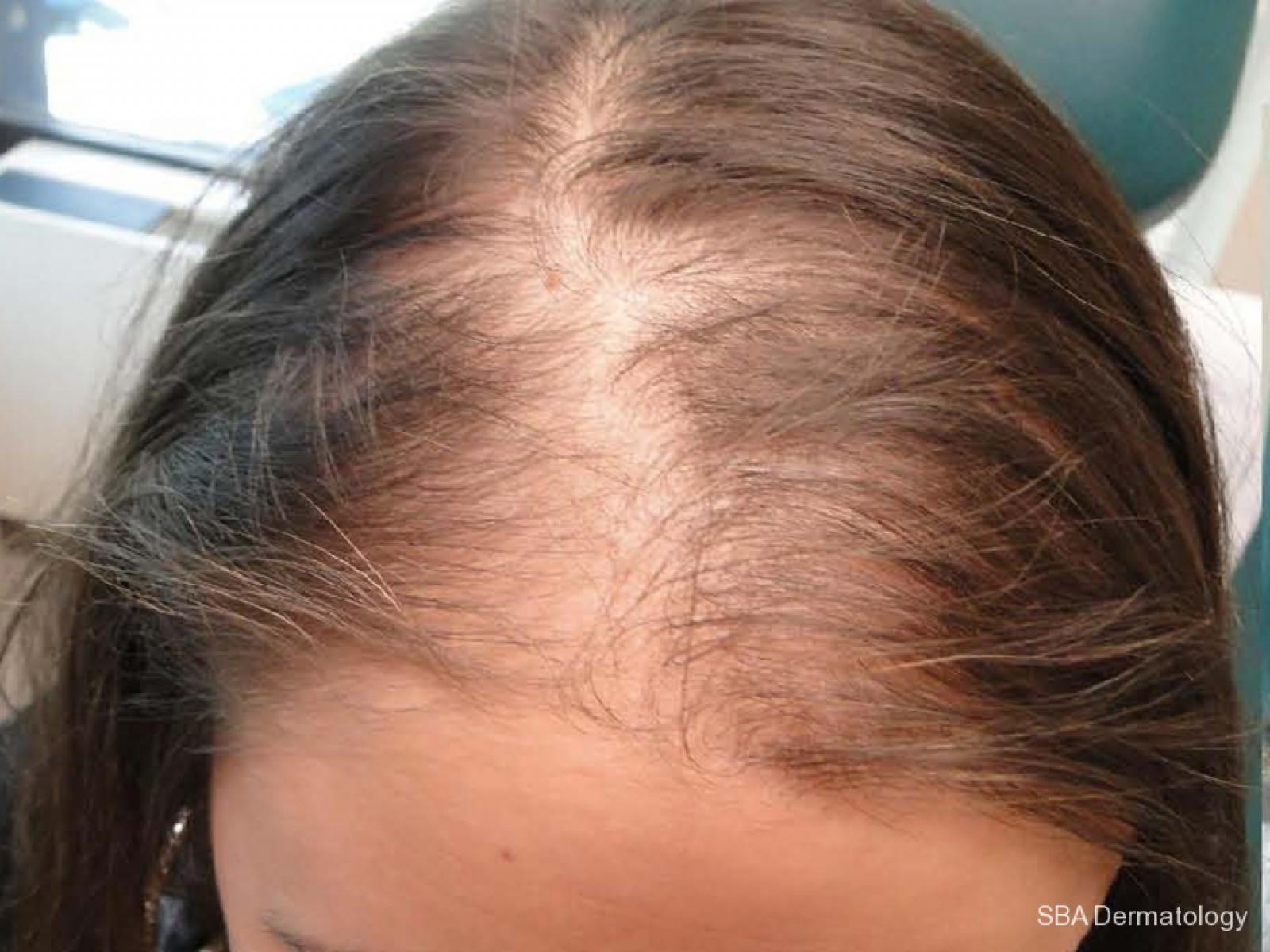 PRP For Hair Loss: Patient 2 - Before 1