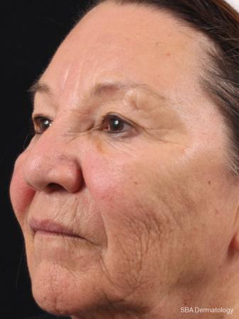 HA Filler: Patient 13 - After 1