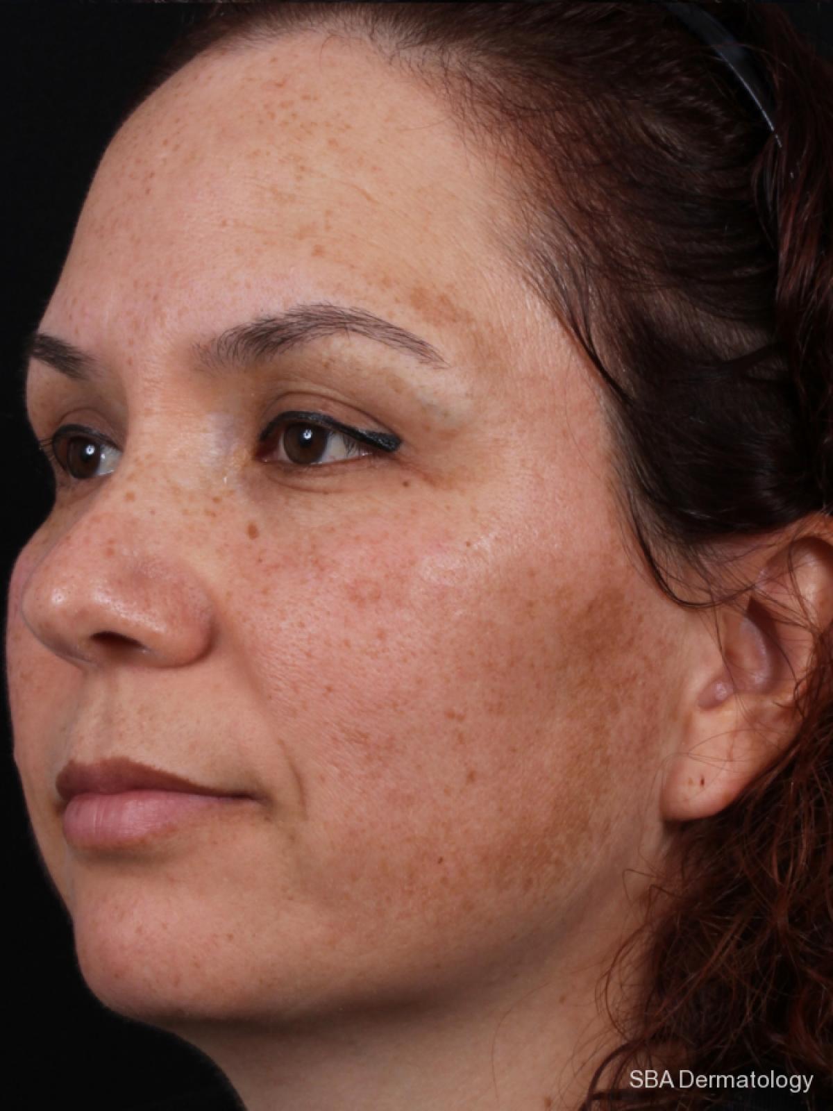 Chemical Peels: Patient 1 - Before 