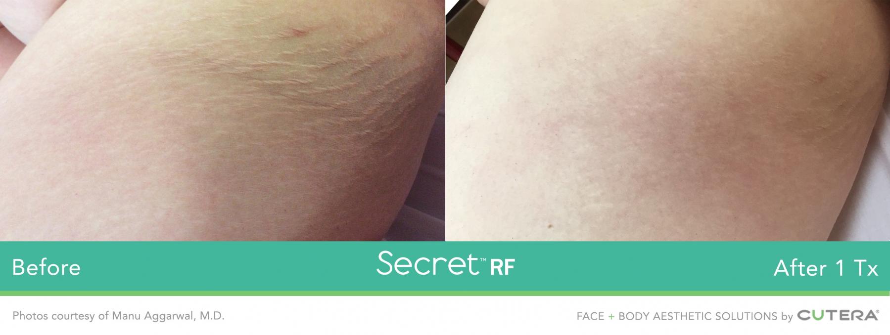 Secret RF: Patient 9 - Before and After  