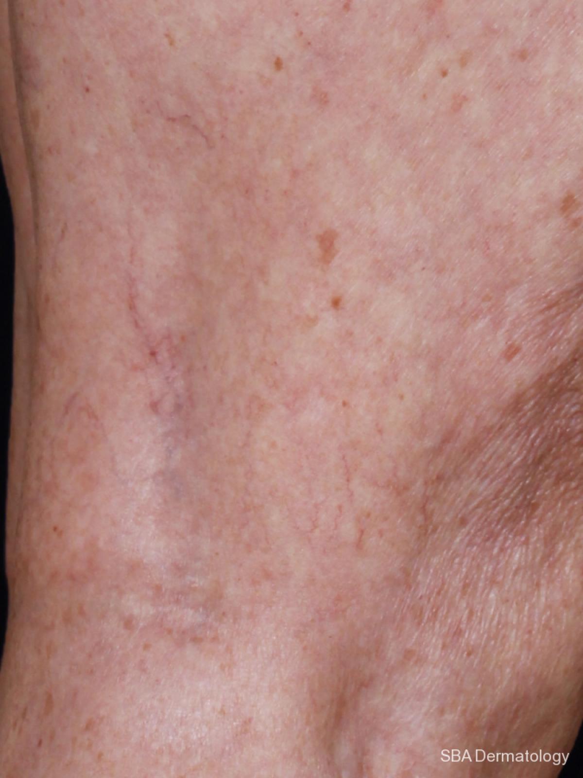 Sclerotherapy: Patient 1 - After 1