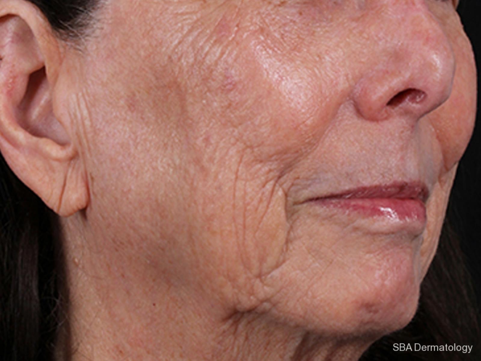 IPL-Photofacial: Patient 1 - After  