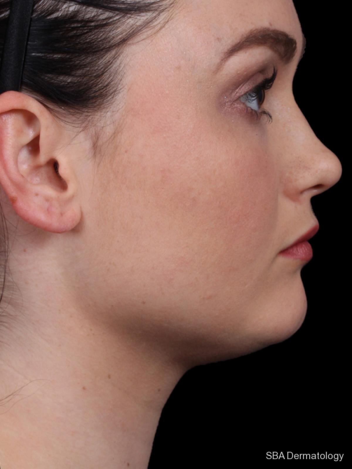 Kybella- Face: Patient 2 - After 1