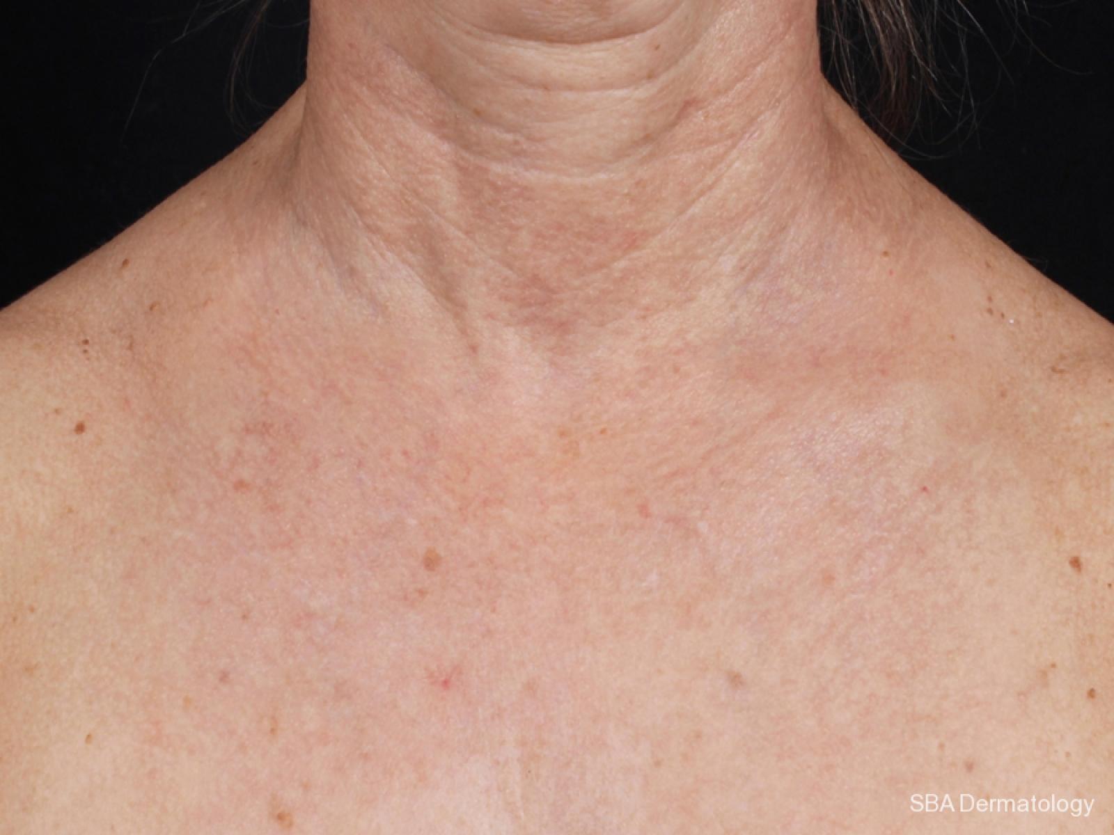 IPL-Photofacial: Patient 4 - After  