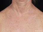 IPL-Photofacial: Patient 4 - After 