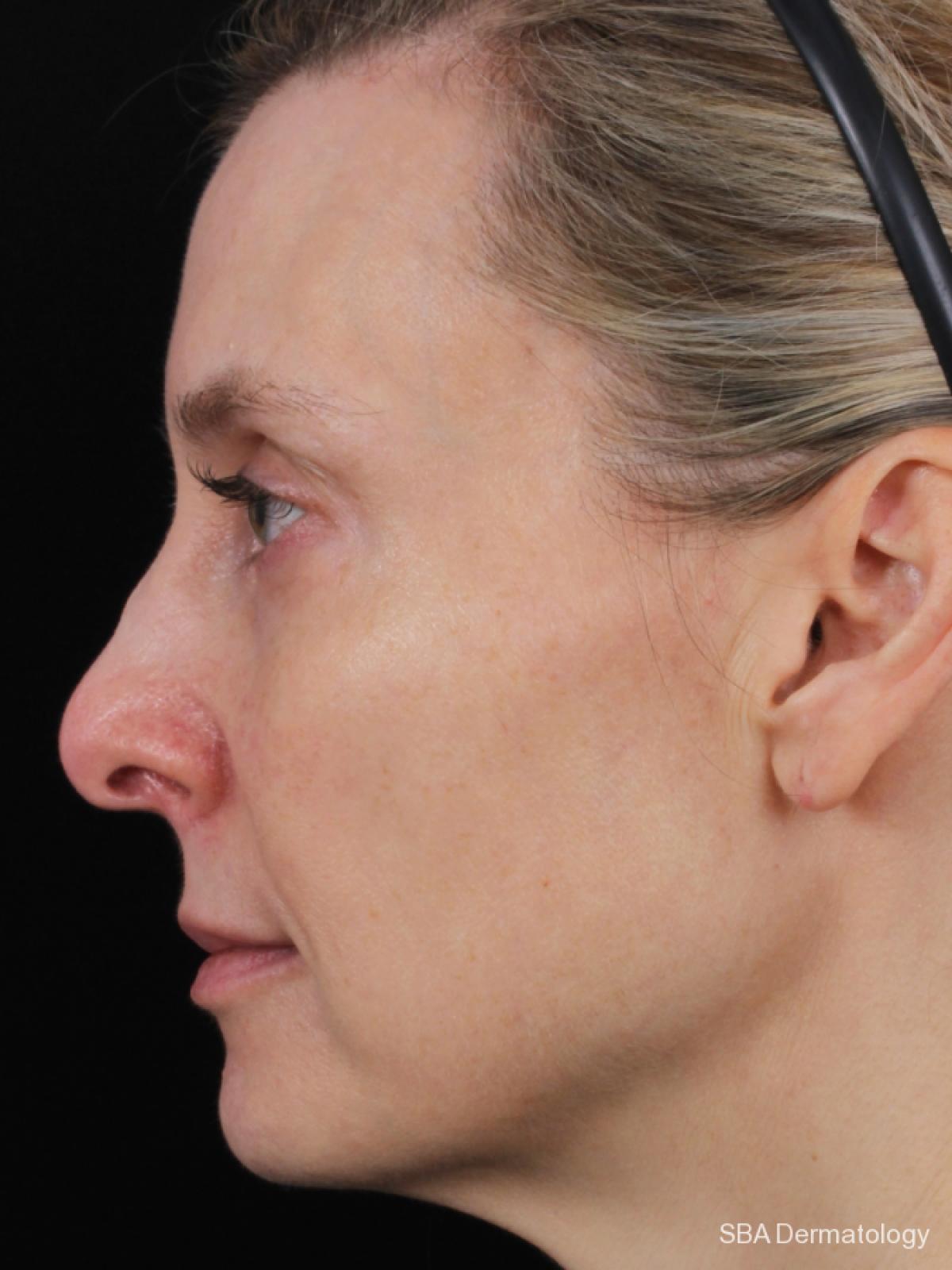 Sculptra-Face: Patient 1 - Before 1