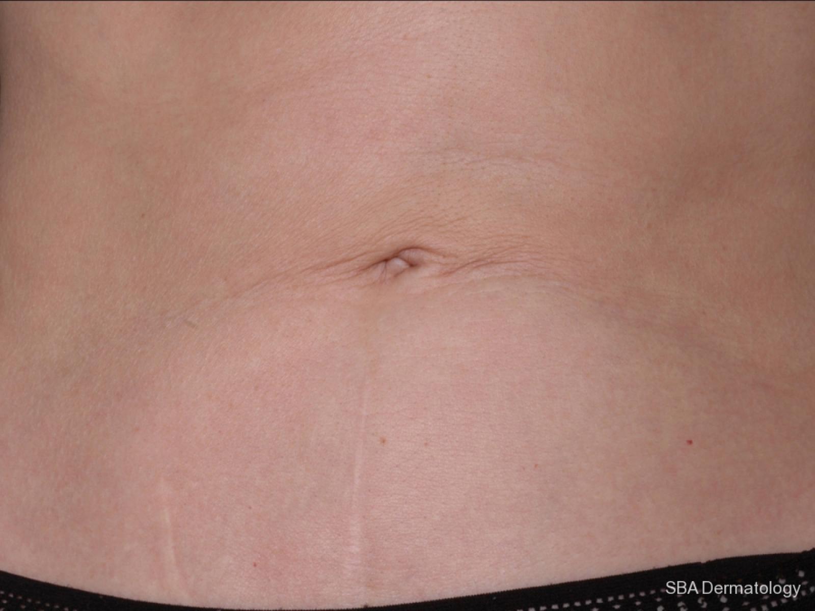 Sculptra-Body: Patient 3 - After 1