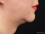 Kybella: Patient 1 - Before 