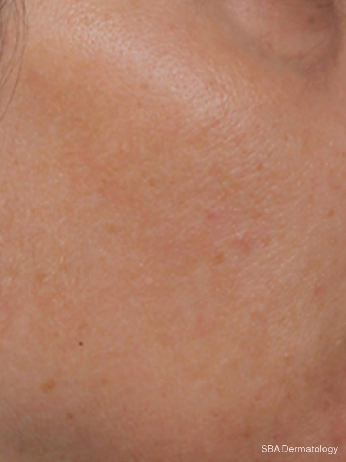 Microneedling: Patient 1 - After 1