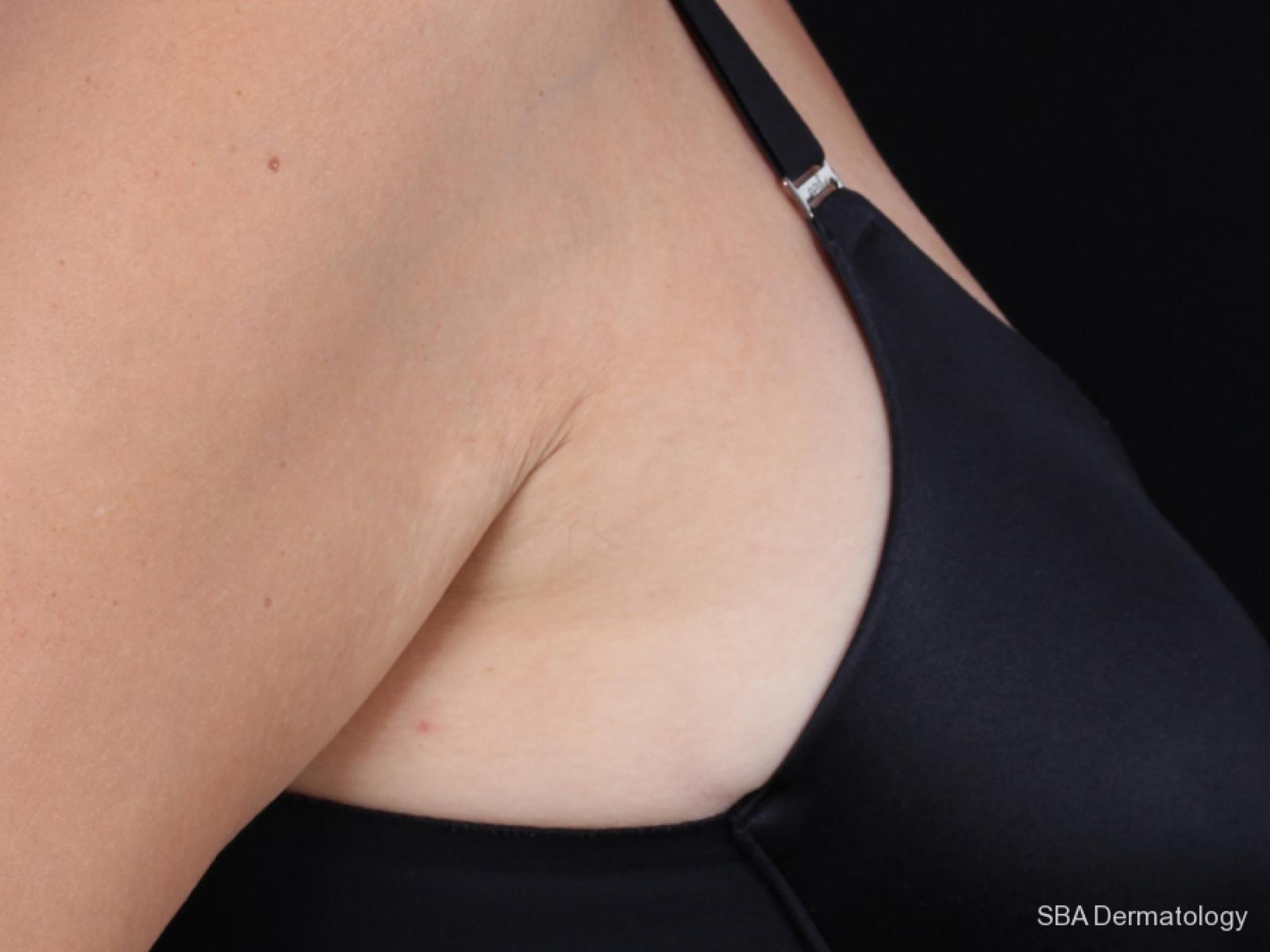 Kybella-Body: Patient 2 - After  