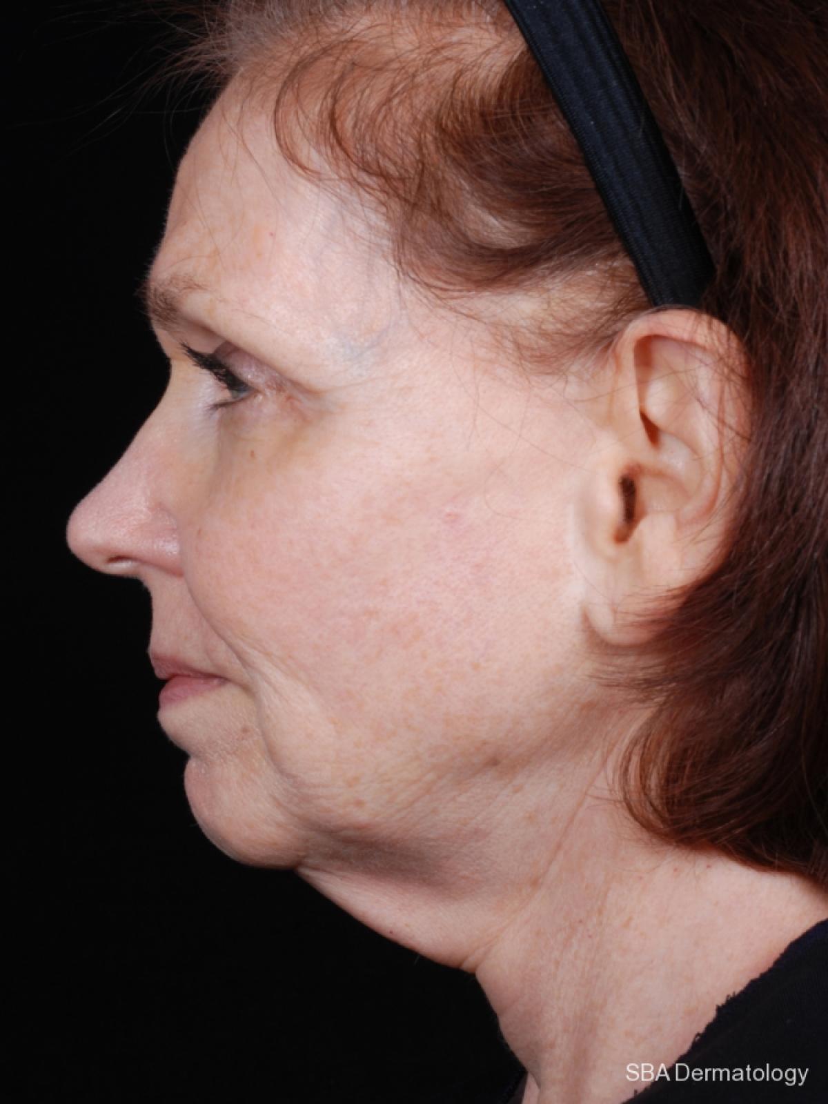 Ultherapy: Patient 2 - After 1
